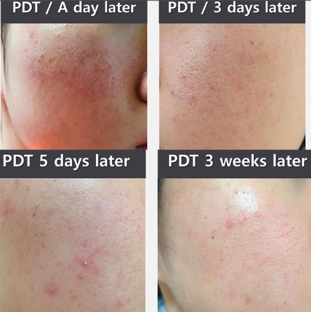 KRX PD 13 Therapy Acne + Rosacea Therapy