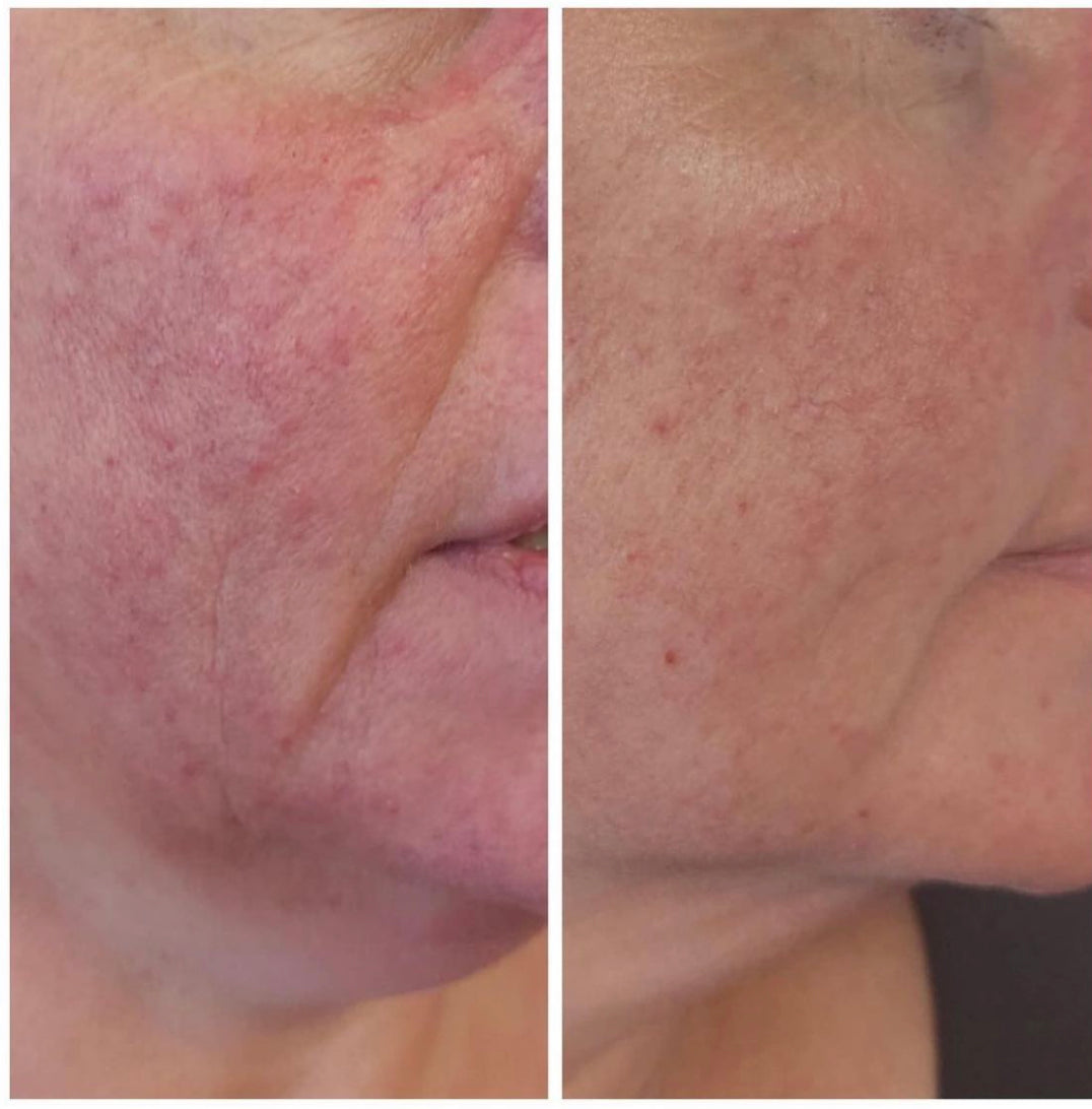 Krx PD 13 Therapy Acne and Rosacea Therapy