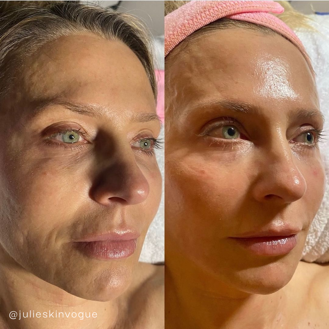 Krx VTox Lift Mask