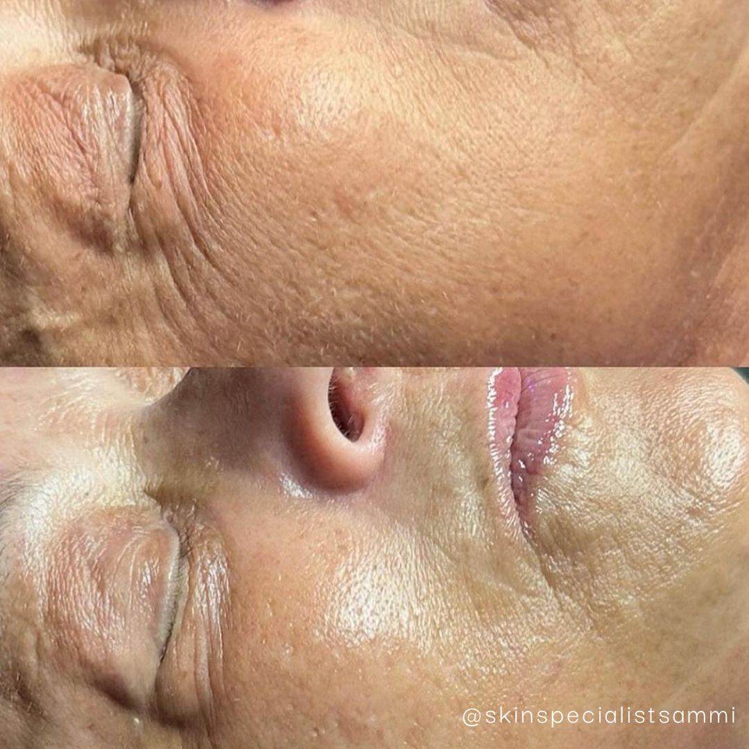 Krx Premium HA Filling Powder