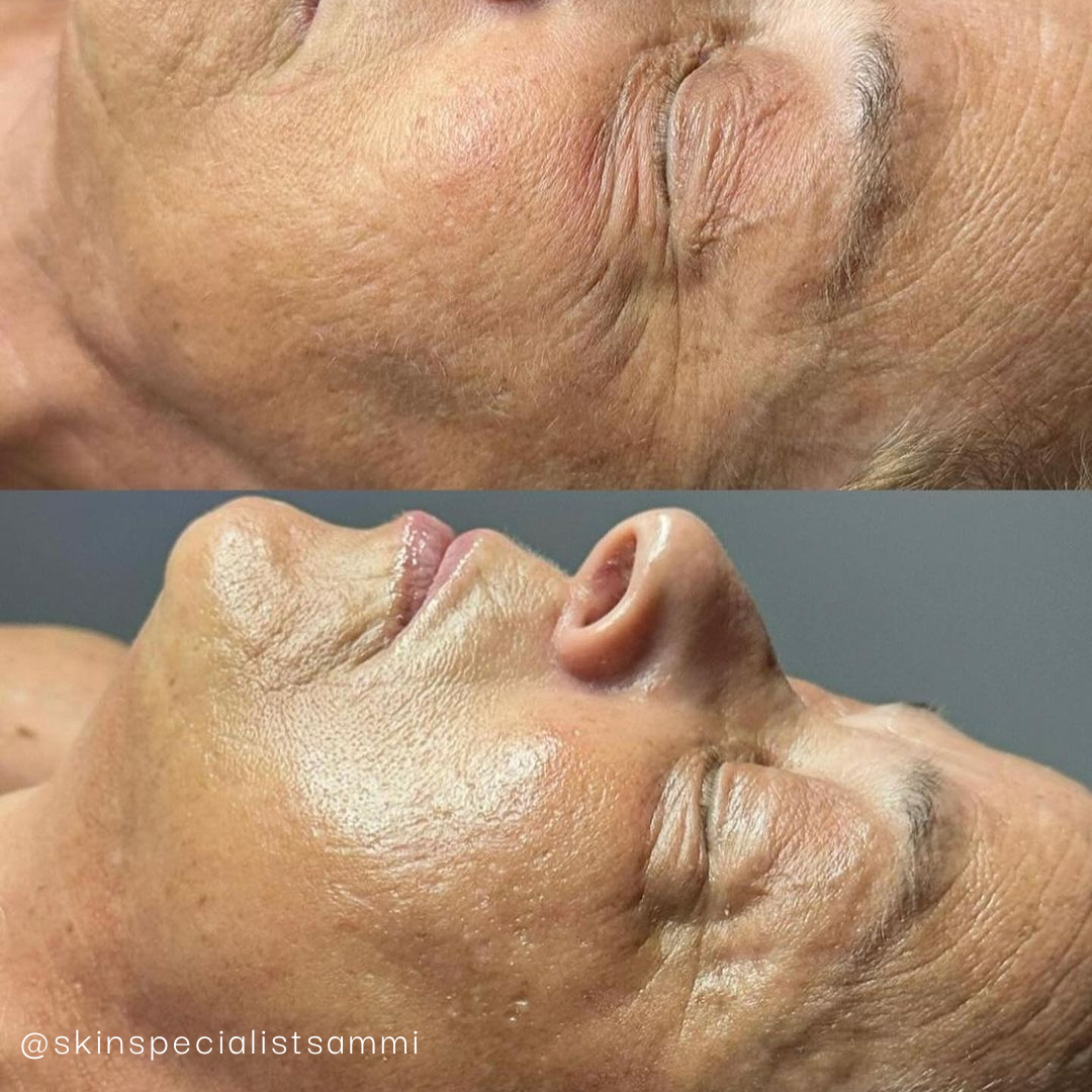 Krx C02 Carboxy Therapy